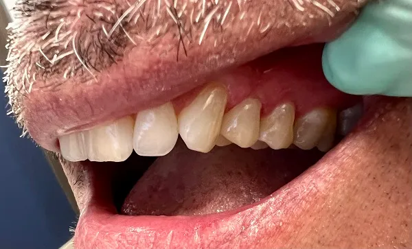 Crowns After