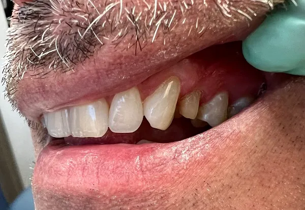 Crowns Before