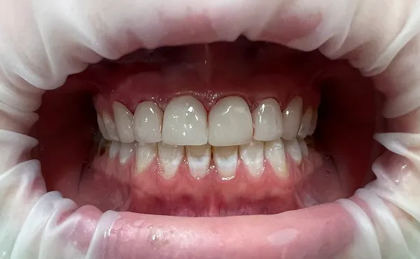Crowns After