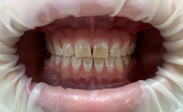 Crowns Before