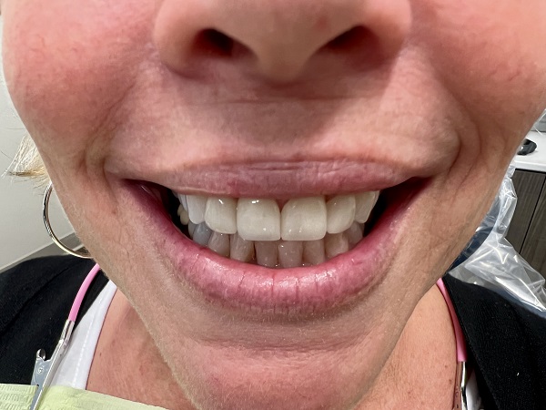 Crowns After