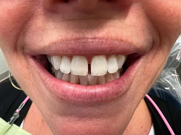Crowns Before