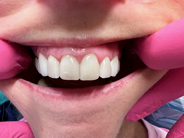 Crowns After