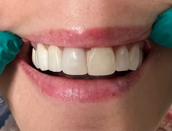 Crowns Before
